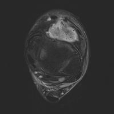 Pseudoaneurysm MRI